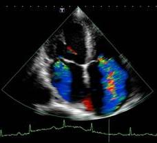 Where to make ultrasound of the heart?